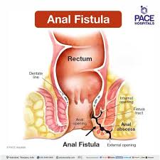fistula symptoms causes types