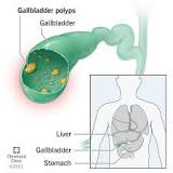 Image result for icd 10 cm code for gallbladder polyp