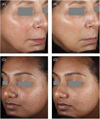 treating acne scars in 2020 use of