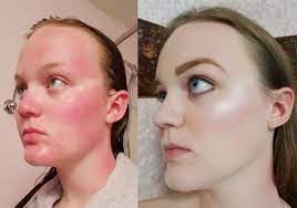 masterfully covered her sunburn with makeup