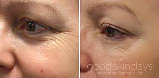 Image result for botox treatment