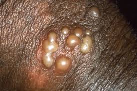 In general, bumps on buttocks is normally defined as the plugged pores, pimples and the cysts. Genital Herpes Nhs