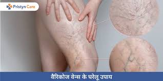 home remes for varicose veins in