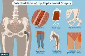 hip replacement surgery recovery what