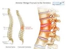 Image result for icd 10 code for t12 wedge compression fracture