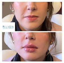 the lip filler healing phase align