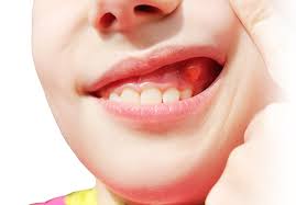 Явление часто сопровождается гормональными сбоями теперь вы знаете, что такое гингивит у детей, его причины, как лечить недуг при прорезывании зубов у малышей, а также какие меры стоит. Chto Delat Esli Opuhla Vospalilas Desna Vozle Zuba I Bolit Otdavaya V Zuby