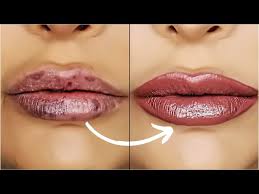 cover bruising from lip filler