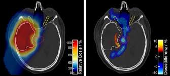 proton therapy improved accuracy