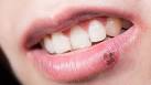 Slideshow: Coping With Cold Sores - WebMD