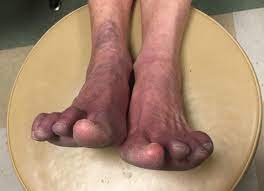 purple feet when sitting common causes