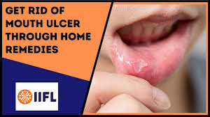 remes for mouth ulcers 5 best