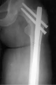 x ray showing reconstruction nail with