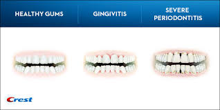 Periodontitis Symptoms Causes And Treatments