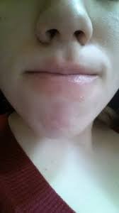 dry skin rash around lips babycenter