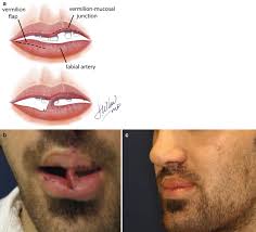 secondary cleft lip repair springerlink
