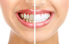 home remes for gingivitis natural