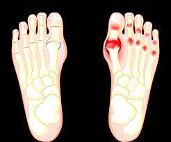 big toe joint pain foot arthritis