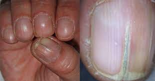 brittle nails