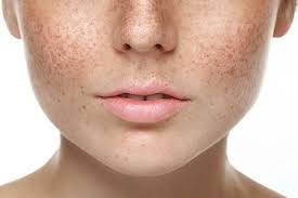 best face skin pigmentation treatment