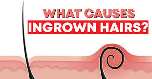 what causes an ingrown hair williams