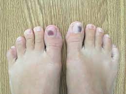 bruised toenails will continuing to