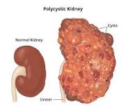 What Is Polycystic Kidney Disease? - NIDDK