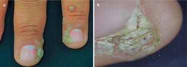 onychomycosis and other nail infections