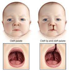 types of cleft cleft hospital