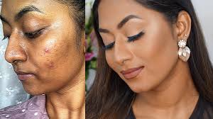 how to cover acne e skin