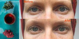 natural remes for puffy tired eyes