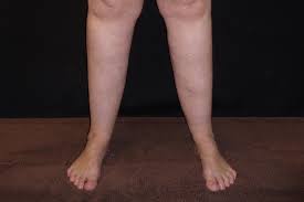 lipoedema nhs