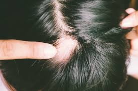 6 ways to stop alopecia areata from
