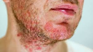 face eczema or another rash