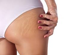 can microneedling help my stretch marks