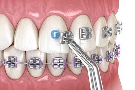 braces family dentistry dental