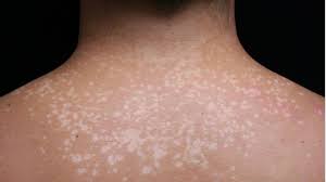 what is tinea versicolor common causes