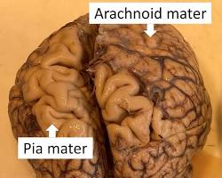 Image of Pia mater brain