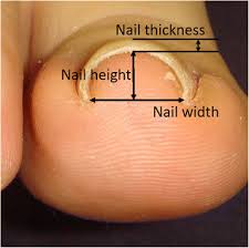pincer nails
