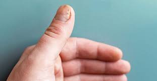 nail psoriasis severity index what it