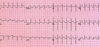 Ecg changes in pericarditis are rather static and changes slowly over the course of several days to weeks. Pericarditis