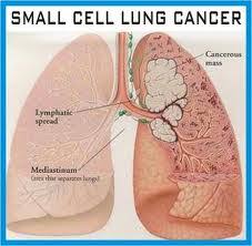 A guide to what you need to know about stage iv lung cancer. Stage 4 Lung Cancer Learn About Cancer Life Expectancy Stage 4 Cancer Life Expectancy
