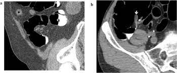 ileocecal valve can mimic a colonic