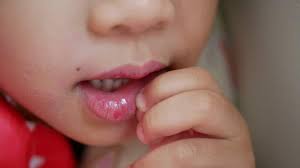 baby mouth ulcers causes treatments