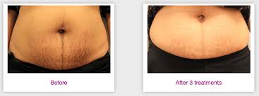 c section scar removal by dermatologist