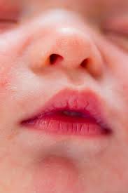 Cluster of itchy and painful blisters on face and neck. 17 Most Common Types Of Baby Rashes With Pictures