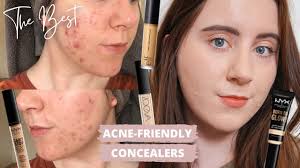 concealers for acne scars