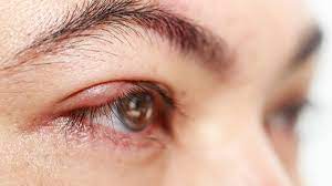 eye styes symptoms causes and