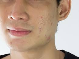 What is that and what really is the difference? Skin Bumps That Look Like Pimples But Aren T Insider
