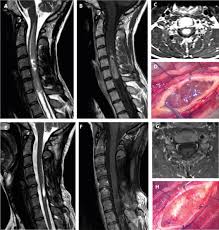 intramedullary spinal cord tumors